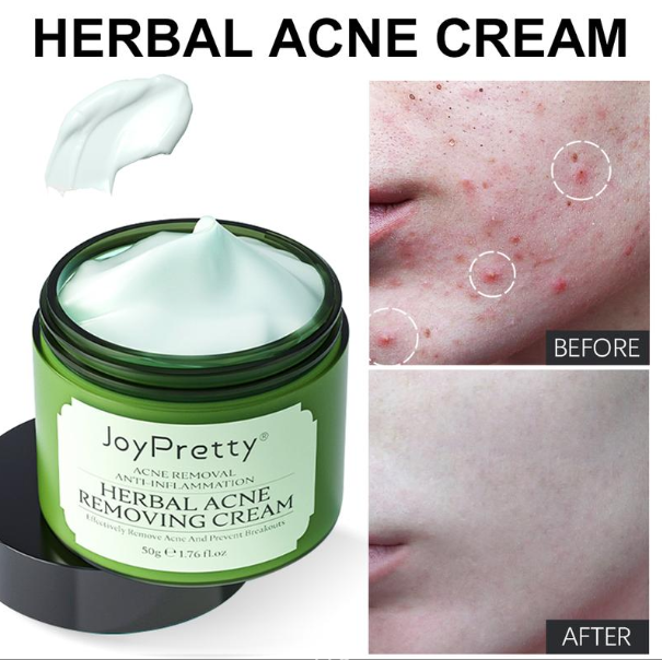 Herbal Acne Cream For Reducing Acne Marks