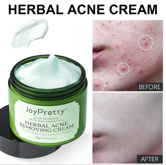 Herbal Acne Cream For Reducing Acne Marks