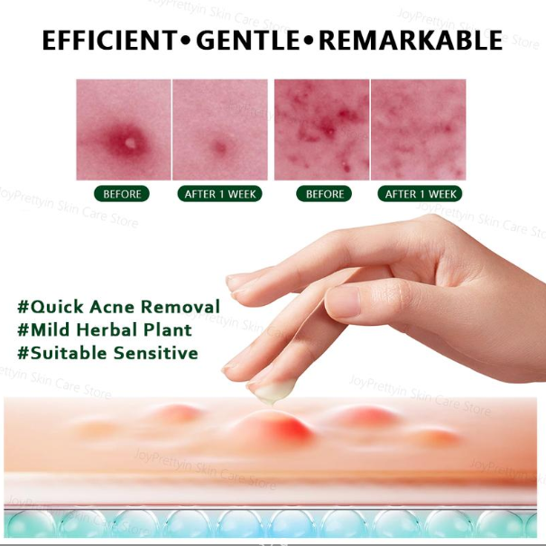 Herbal Acne Cream For Reducing Acne Marks