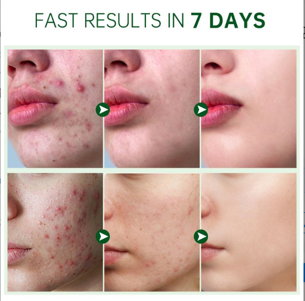 Herbal Acne Cream For Reducing Acne Marks